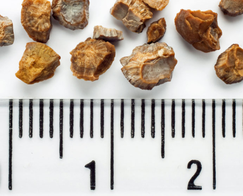 Kidney stones sizes