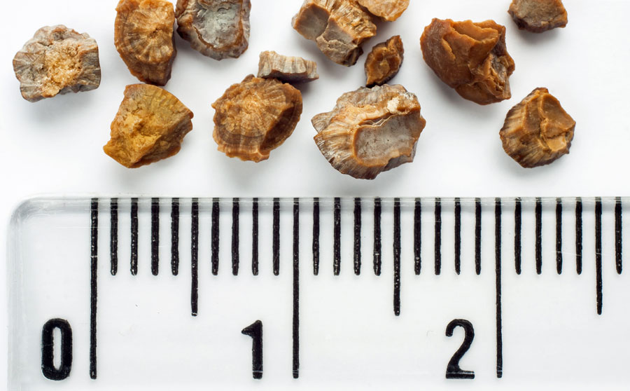 Kidney stones sizes